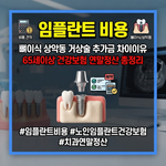임플란트 비용